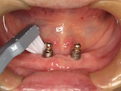 Photograph showing the cleaning of abutment with a single-tuft toothbrush.