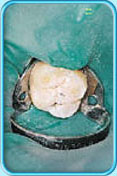 Photograph of a molar after cleaning.
