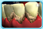 Animation showing severe gum recession that makes a tooth becomes loose and about to fall out.
