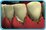 Photograph of a set of teeth with red and swollen gums calculus accumulated along the gum margin.