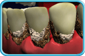 Photograph of the gum margin being accumulated with calculus  and the gums look severely red and swollen.  Gum recession occurs  leadings to exposed root surfaces which makes the tooth look longer.