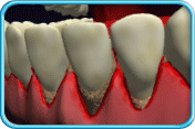 Photograph of the gum margin being accumulated with calculus and the gums look severely red and swollen. Gum recession occurs  leading to exposed root surfaces which makes the tooth look longer.
