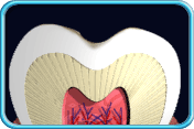 图中所见是患有初期蛀牙的牙冠纵切面。