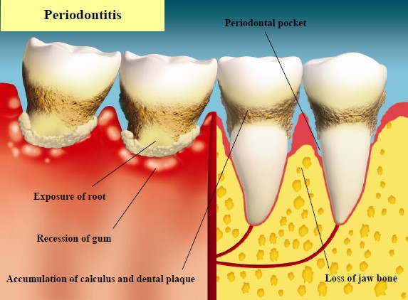 Photograph shows the condition of periodontitis. Its symptoms include exposure of root, recession of gum and bone as well as the accumulation of calculus and dental plaque.