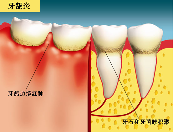 图中所见是患有牙齦炎的情况，徵状包括牙齦边缘红肿、牙齿表面有牙石和牙菌膜积聚。