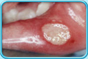 Photograph showing the presence of aphthous ulcer on the lip that is yellowish with a reddish margin.