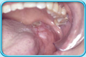 Photograph showing an oral tumor at the back of upper jaw.