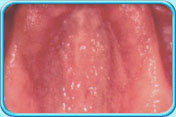 Photograph of denture induced Stomatitis of the upper jaw.