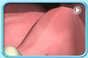 Animation showing an erupting lower wisdom tooth having its overlying periodontal tissues resorbed gradually until at the end the tissues become red and swollen.
