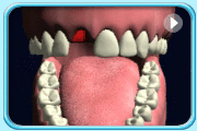 Animation showing how the tooth is put back into the socket.