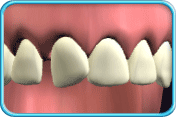 圖中所見是恆齒上排一顆正門牙已稍微偏離原來的位置。