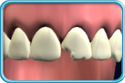 圖中所見是恆齒上排一顆正門牙的牙冠有部分折斷。