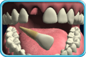 图中所见是恒齿的上排一颗正门牙整颗飞脱掉。
