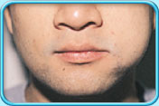 图中所见是一名患者左边脸颊肿胀。