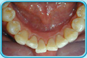 图中所见是清除黑色牙渍后的下排牙齿。