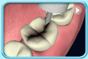 Animation showing the use of dental instruments to remove the decayed portion of a tooth and fill with amalgam.