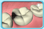Animation showing the use of dental instruments to remove the decayed portion of a tooth and fill with glass ionomer cement.