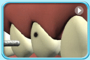 Animation showing the use of dental instruments to remove the decayed portion of the tooth and fill with compomer.