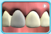 动画所见是镶制搪瓷人造牙冠的过程。
