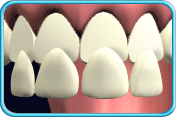 Photograph showing a veneer that matches the upper front teeth.