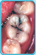 Photograph of decayed tooth before a filling is placed.