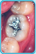 Photograph of decayed tooth after an amalgam is placed.