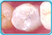 Photograph of a decayed tooth after filling with composite.