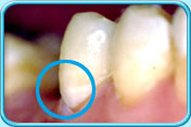 Photograph showing the abraded portion of the tooth being filled by glass ionomer cement.
