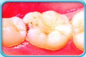 Photograph of a decayed deciduous tooth before  a filling is replaced.