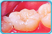Photograph of a decayed deciduous tooth after filling with glass ionomer cement.
