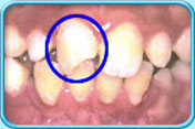 Photograph showing an incisor with a fracture at the biting edge.