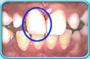 Photograph showing the fractured portion of the incisor (circled in blue) being restored to its original condition.