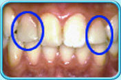 Photograph showing two originally smaller lateral incisors (circled in blue) being built up to improve appearance.