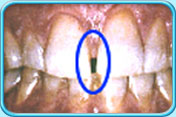 Photograph showing a wide space between two upper incisors.