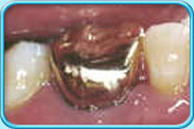 图中所见是镶配了合金人造牙冠的臼齿。