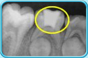 Photograph of an x-ray film indicating a deciduous molar with partial removal of pulp tissues.