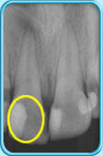 图中所见是一张X光片，显示一颗牙髓已坏死的恒门牙。