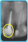 图中所见是一张X光片，显示一颗接受了清除全部牙髓的治疗之后的恒门牙。