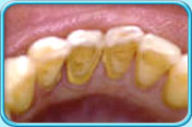 Photograph of lower front teeth with calculus before scaling.