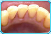 Photograph of the clean lower front teeth after scaling.