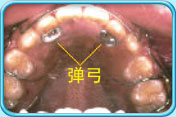 图中所见是上颌和附在上颌的活动牙齿矫正器，并指出弹弓的所在位置。