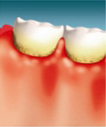 Dental plaque and calculus accumulated at the gum line