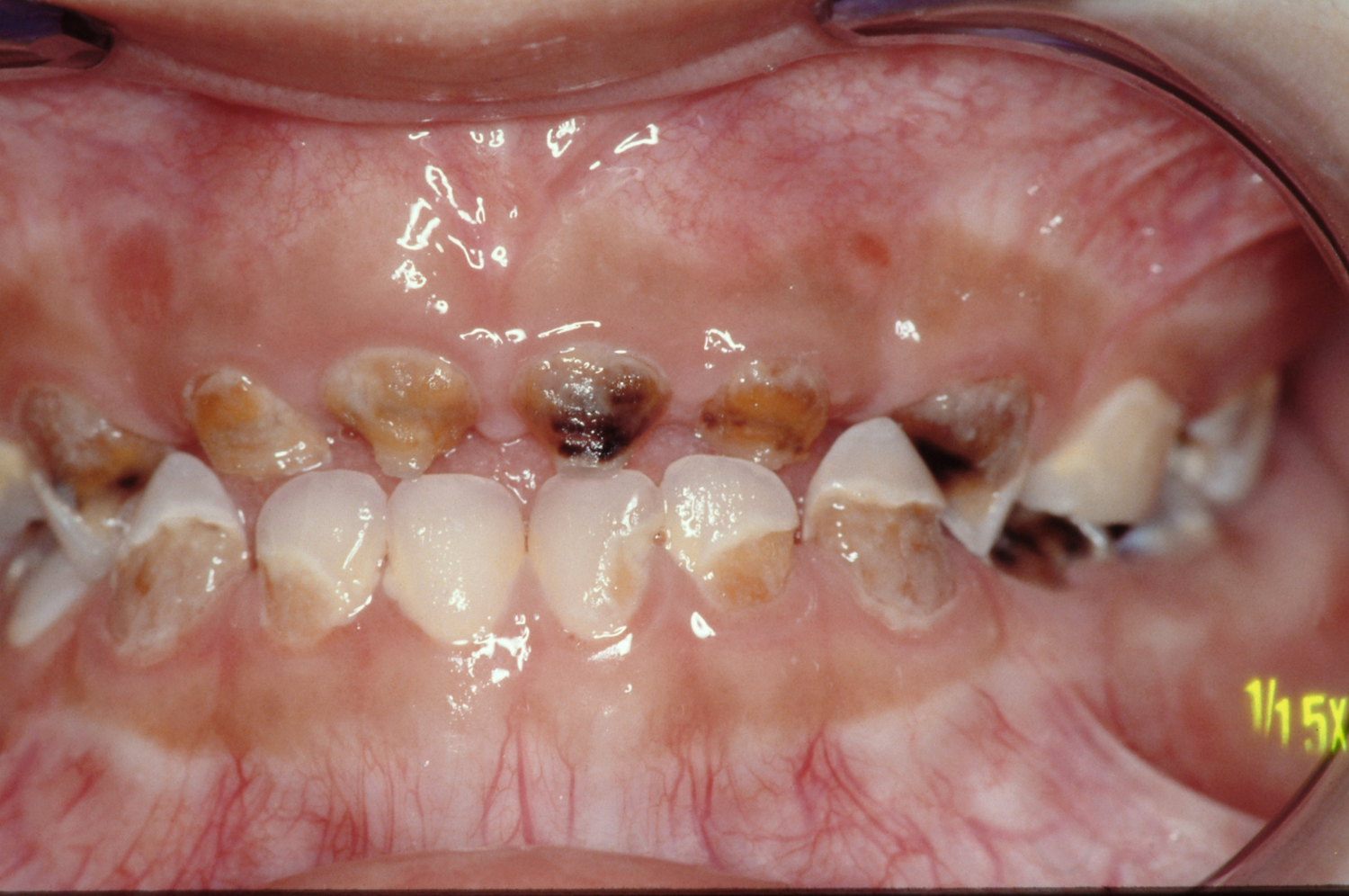 Child with multiple tooth decay.