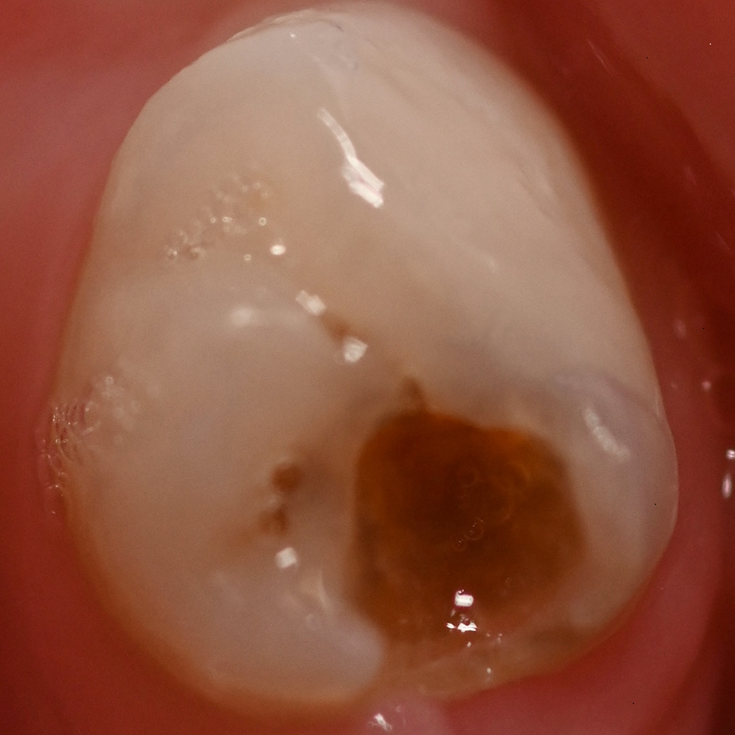 A decayed tooth before and after SDF treatment. (Before)