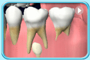 Animation of the process of how a severely decayed deciduous tooth disturb the development of the enamel of its permanent successor resulting in the formation of brownish-yellow patches on the tooth.