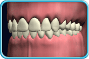 Photograph of a set of yellowish permanent teeth.
