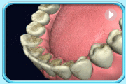 Animation showing the use of prophyjet to remove the stains on the lower teeth.