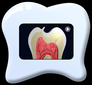 Animation showing the use of dental material to strengthen the projected tooth structure of a Leong's premolar.
