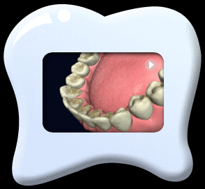 Animation showing the ultrasonic cleaning device to remove stains from the tooth surfaces resulting in clean teeth ultimately.