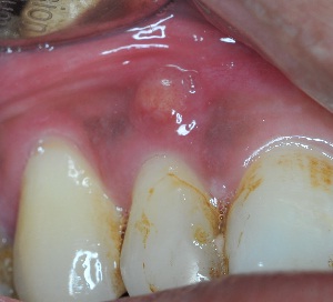 Photograph showing an abscess near a tooth.
